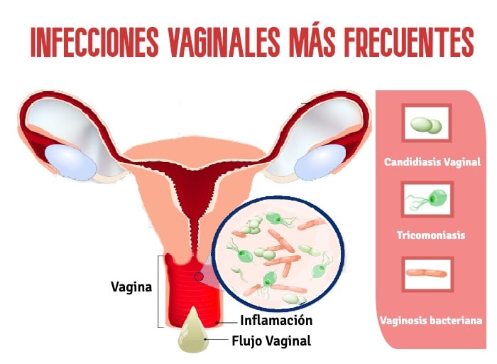 Infografía sobre las principales infecciones ginecológicas e infecciones vaginales más frecuentes