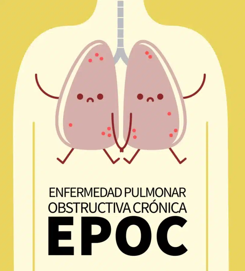 farmacos-del-sistema-respiratorio-para-pacientes-con-epoc Dibujo educativo que representa a dos pulmones afectados por EPOC dentro del cuerpo humano, útil para explicar síntomas respiratorios crónicos y su manejo farmacológico